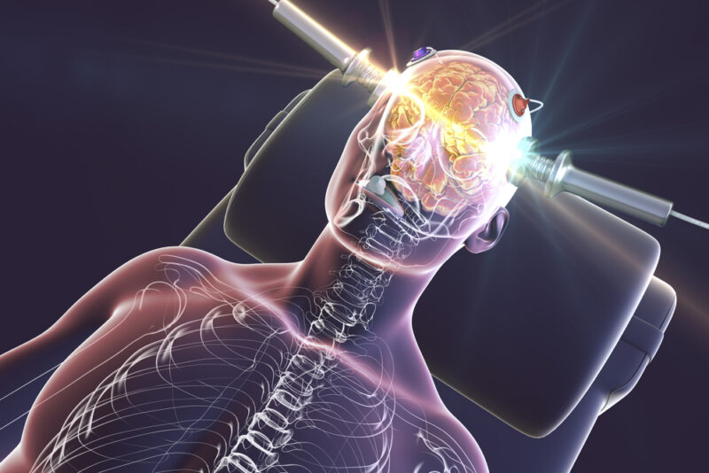 Electroconvulsive therapy, ECT, a treatment involving the use of electrical currents to stimulate the brain, 3D illustration 3 d plaatje van ECT