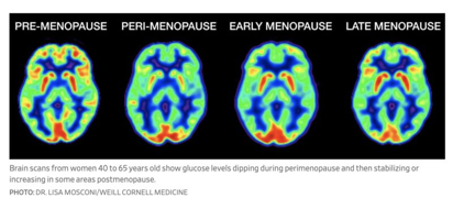 Hersenscans van vrouwen tussen de 40 en 65 jaar laten zien dat de glucosespiegels tijdens de perimenopauze dippen en na de menopauze stabiliseren of omhooggaan. Roodgekleurde hersengebieden geven hoge glucose levels en dus hoge hersenenergie weer; tijdens de peri- en vroege menopauze zijn veel gebieden significant minder energie dan daarvoor en daarna. Deze figuur werd op de sociale media geplaatst door de onderzoeksgroep van Prof. Mosconi en is gebaseerd op de PloS One publicatie uit 2017.
