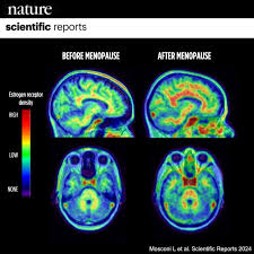 F-FES PET scans van pre- en postmenopauzale vrouwenhersenen, die de dichtheid van estradiol receptoren voor en na de menopauze laten zien. Roodgekleurde hersengebieden geven een hoge dichtheid van estradiolreceptoren weer; het aantal receptoren neemt significant toe na de menopauze vergeleken met daarvoor. Deze figuur werd op de sociale media geplaatst door de onderzoeksgroep van Prof. Mosconi en is gebaseerd op de Nature publicatie uit 2024.